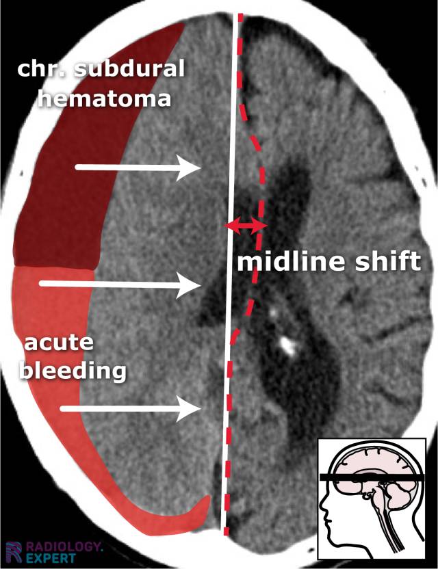 CT brain hemorrhage